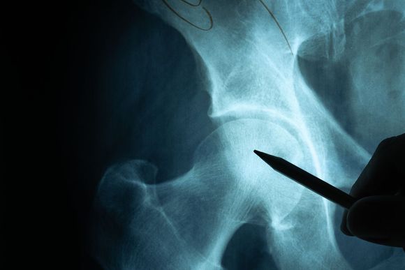 小孩股骨中段骨折错位算十级伤残吗