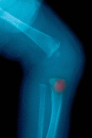 腿骨折治好后从钢钉处又折了，理赔流程是什么